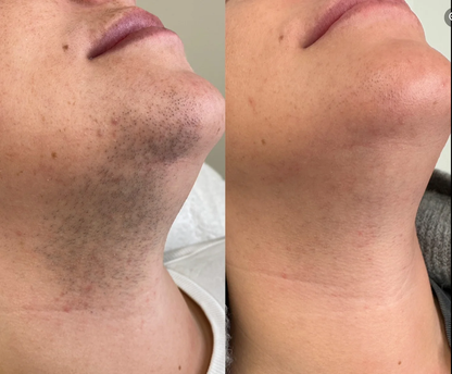 Lumiva™ Kit dépilatoire 1+1