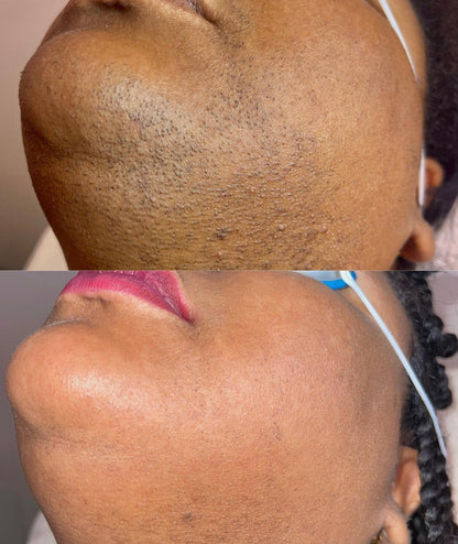 Lumiva™ Kit dépilatoire 1+1