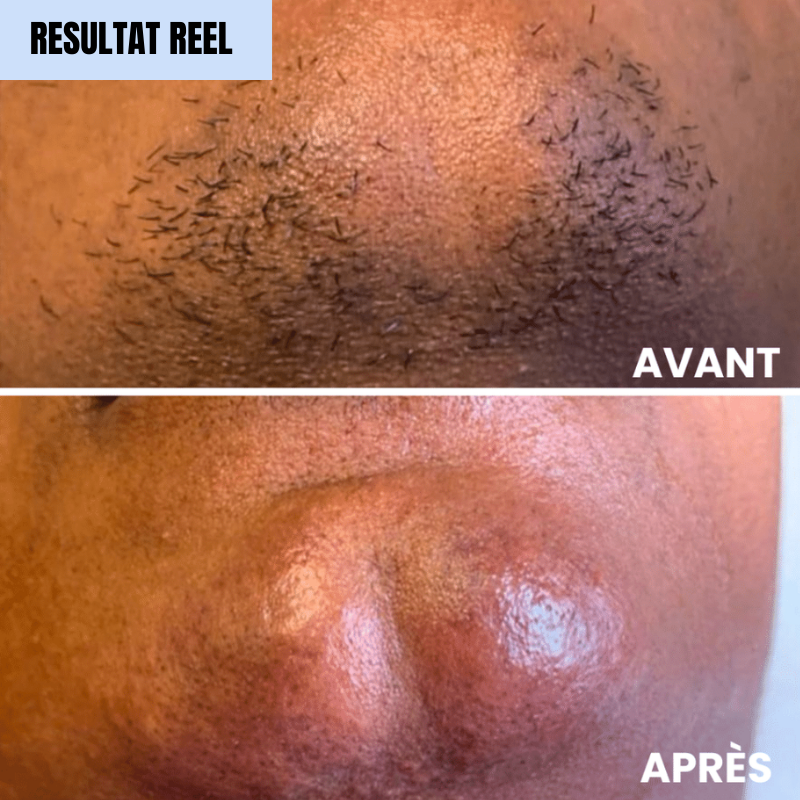 Lumiva™ Kit dépilatoire 1+1