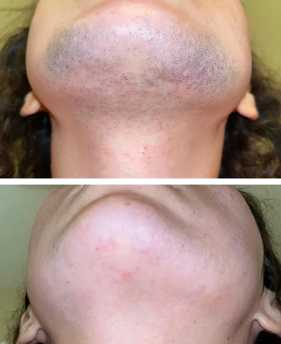 Lumiva™ Kit dépilatoire 1+1